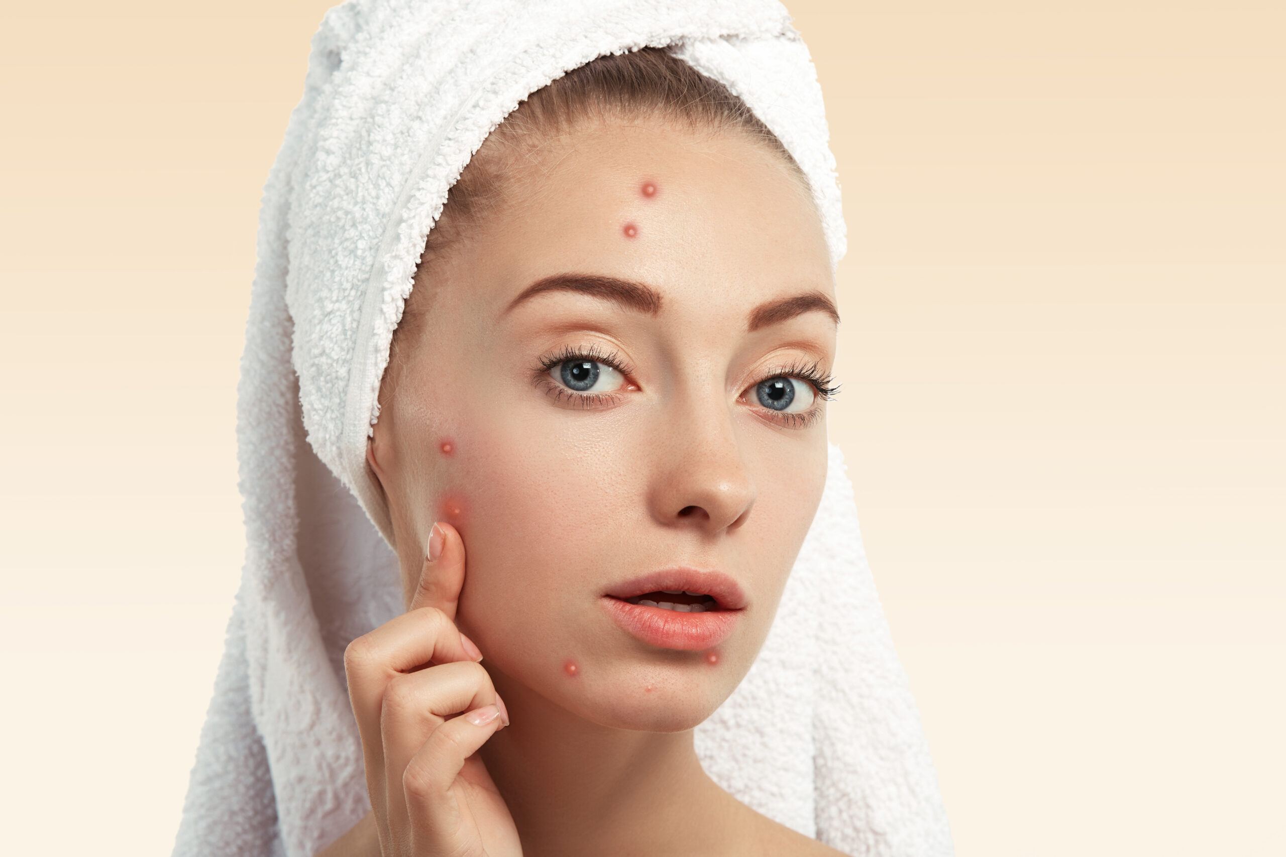 Homeopathic Remedies for Acne