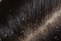 Best Homeopathic medicines for Dandruff