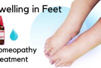 Swelling In Feet Swelling In Feet
